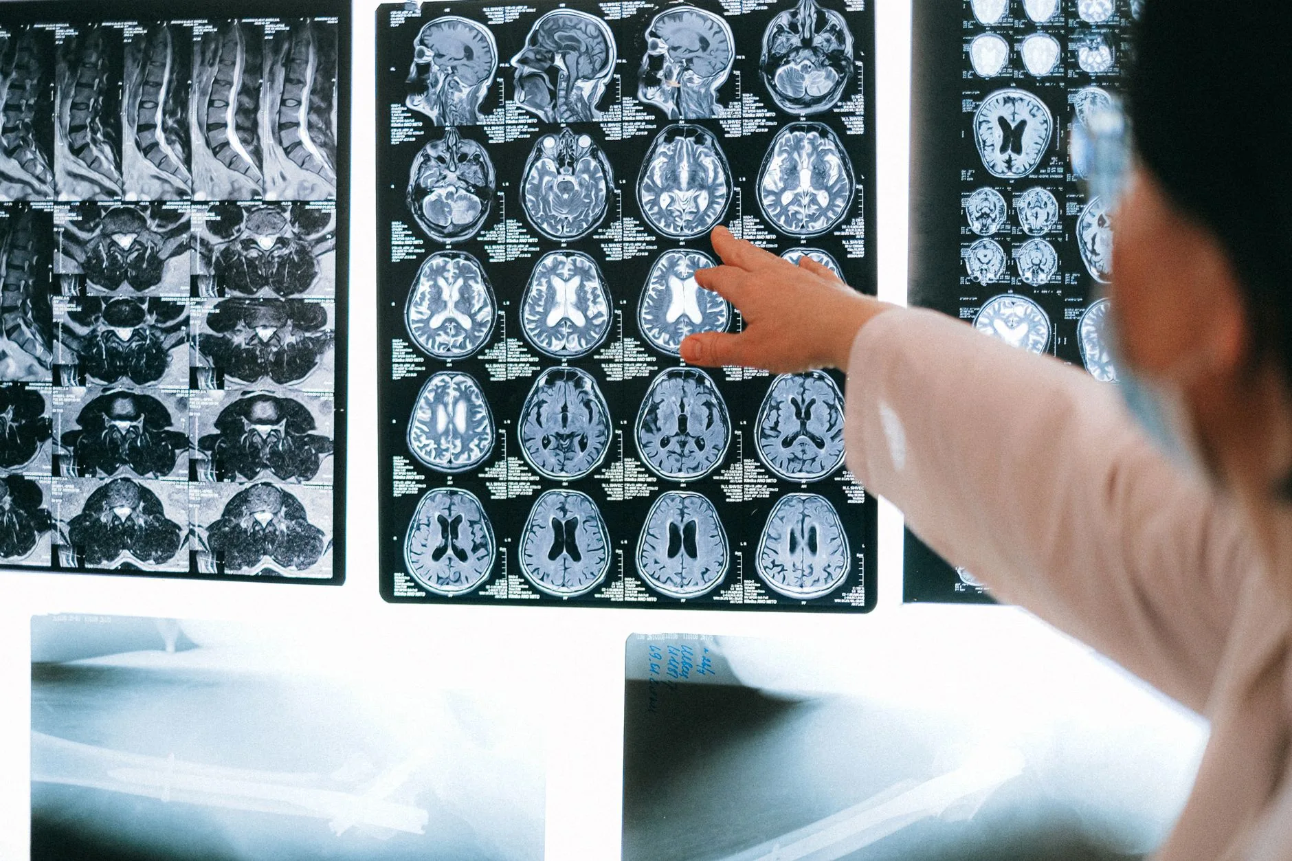 does epilepsy cause memory loss — brain scan temporal lobe epilepsy hippocampus memory